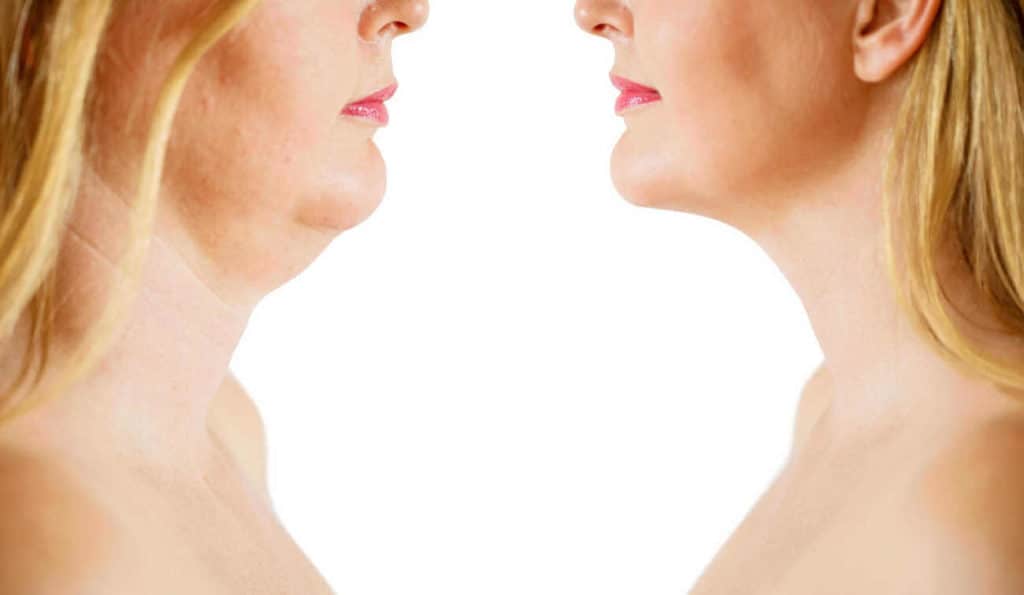 Double Chin treatment Golders Green before and after results