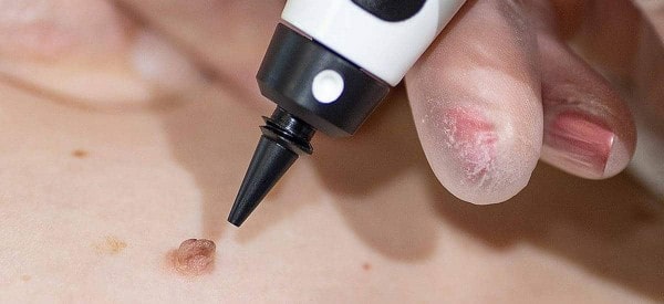 After Skin Tag Removal Golders Green