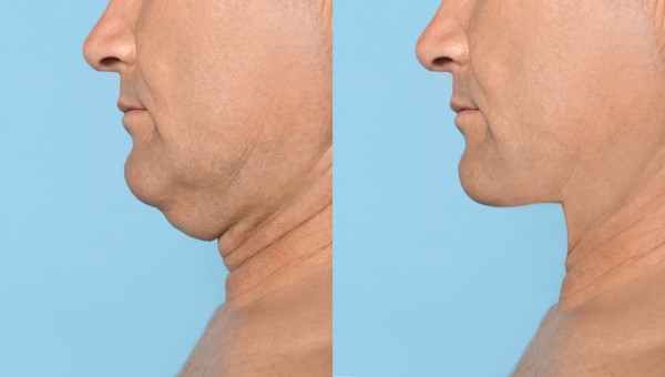Which Non-Surgical Treatments Work Best for Jowls and Loose Skin Golders Green?