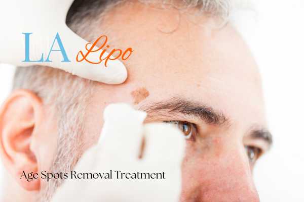 What Are the Most Effective Treatments for Age Spots Golders Green?