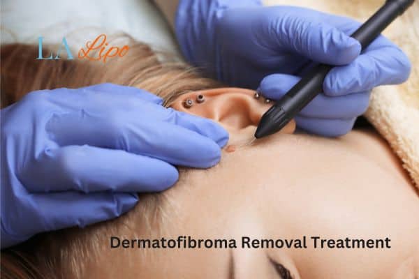 Dermatofibroma Removal Treatment Golders Green