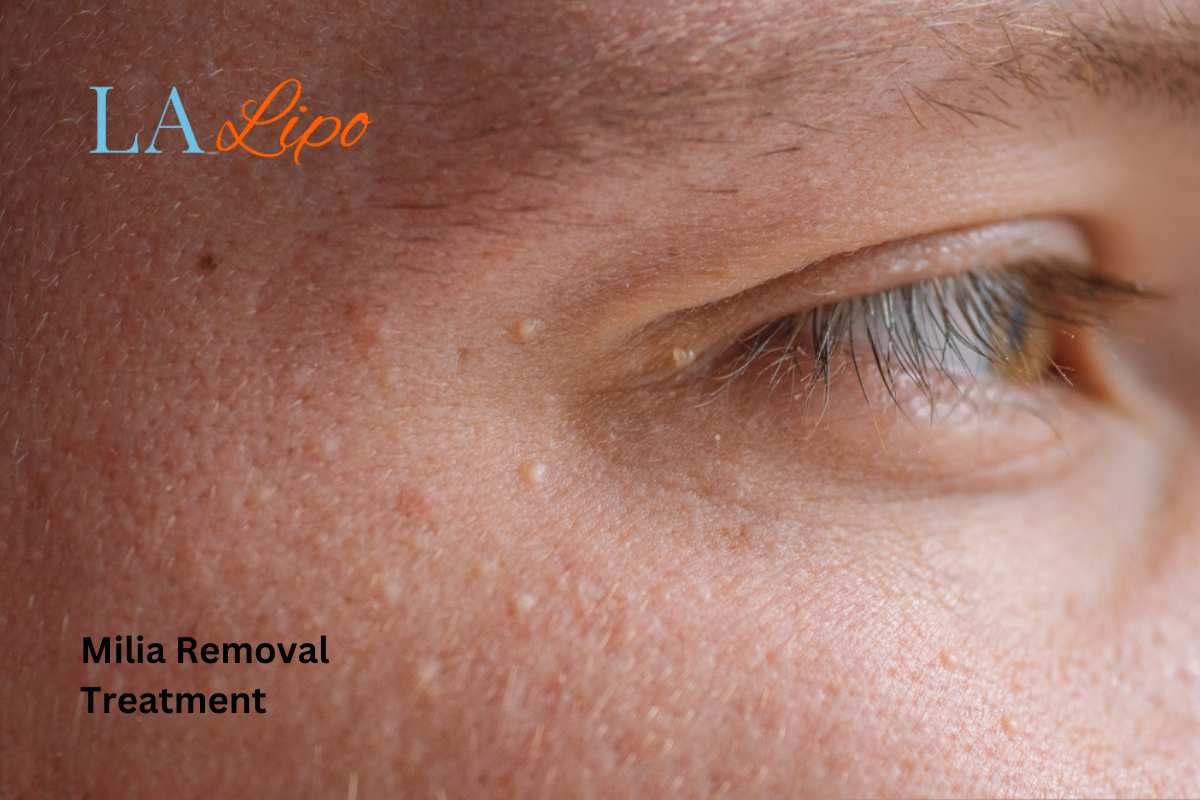 Cryopen Milia Removal: Is It the Easiest and Safest Option Golders Green?