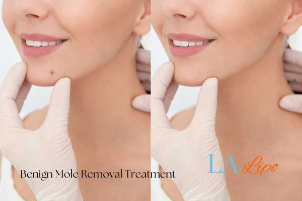 Before-and-after results following benign mole-removal treatment Golders Green