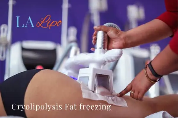 women getting fat freezing Golders Green