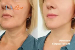 hi-fu for wrinkles Golders Green before and after results