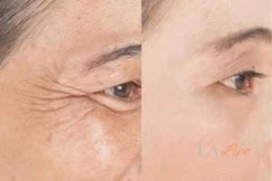 Before and after results of woman - HI-fu wrinkles reduction treatment Golders Green