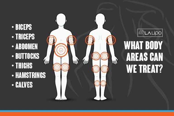 Graphic to show areas you can have LA-EMS Body Sculpting Golders Green treatment.
