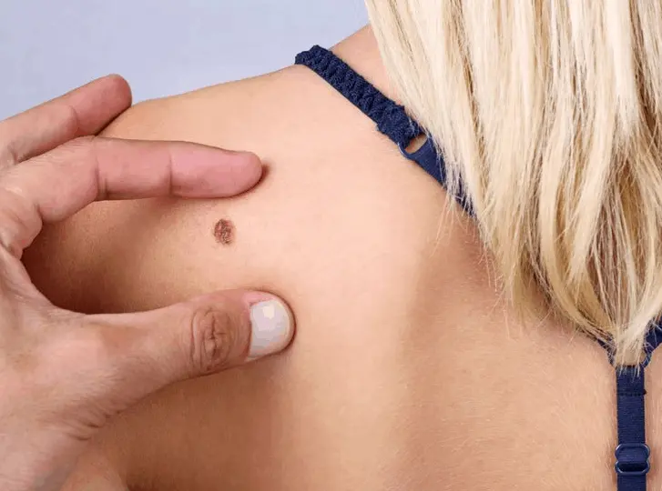 woman having mole removal Golders Green consultation before treatment.