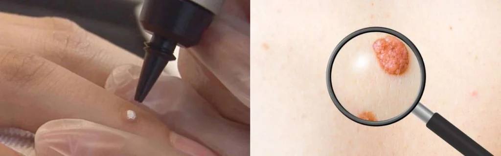 CryoPen practitioner Golders Green assessing a benign mole before treatment