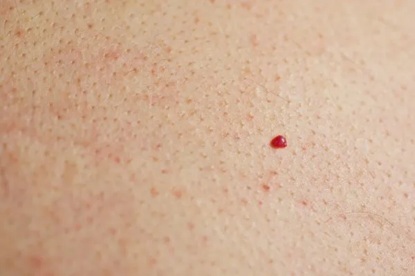 close up of a cherry angioma Golders Green