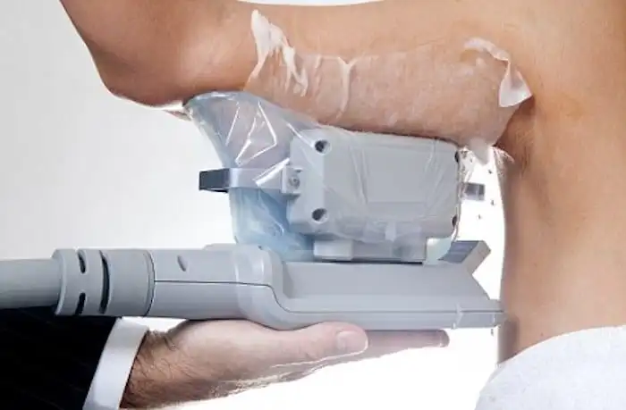 Picture of fat freezing Golders Green on the upper arms.