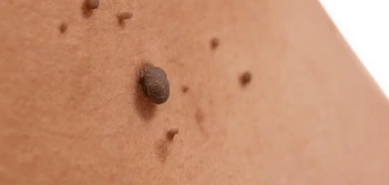 image of a skin tag Golders Green