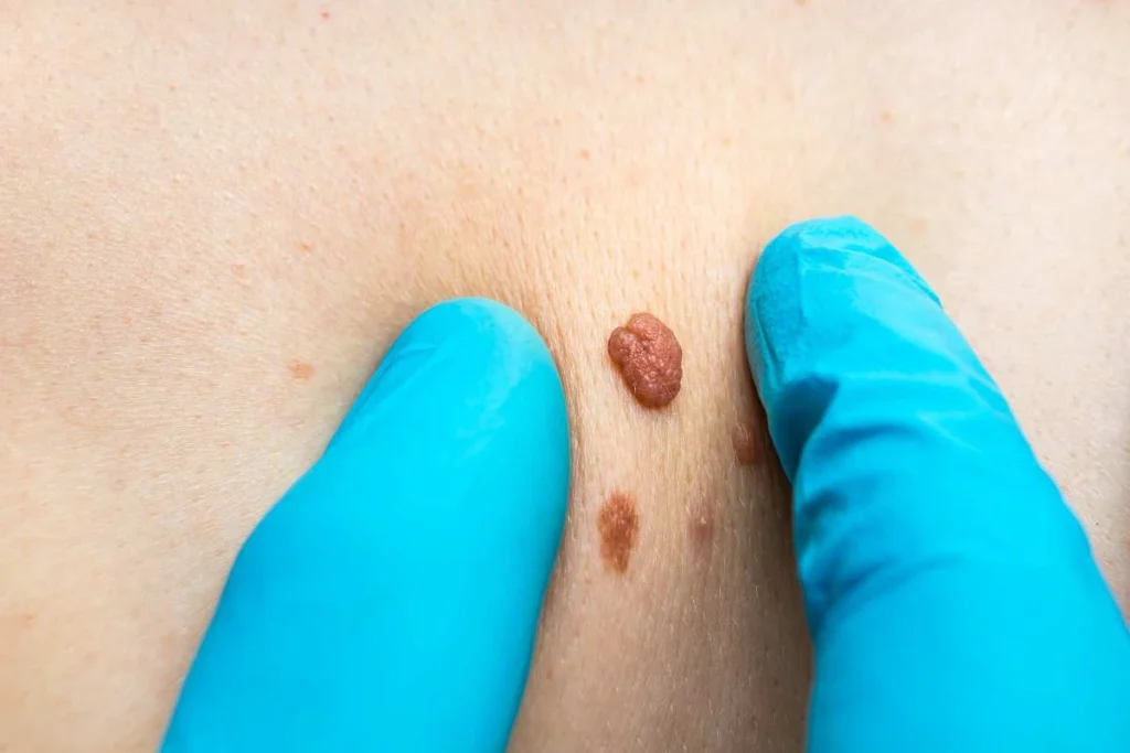 Consultant examining a skin tag Golders Green