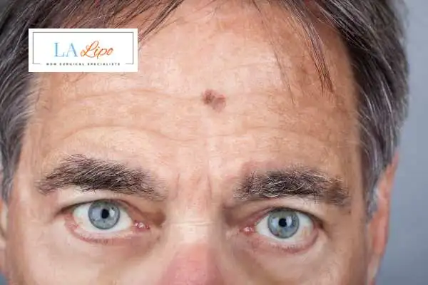 Solar Lentigo Removal Golders Green image of man with mark on his forehead