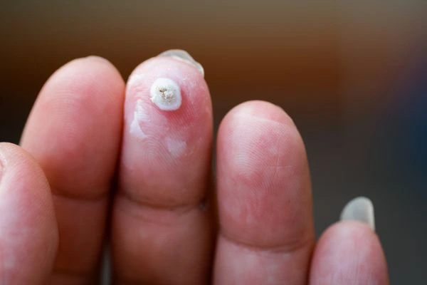 wart on person finger - cryotherapy to treat from LA LIPO Golders Green