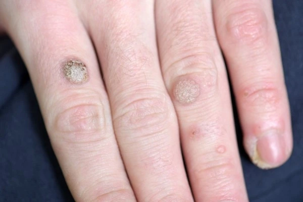 photo of warts on person hand - see wart removal Golders Green from LA LIPO