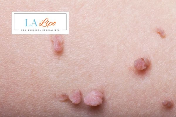 Does cryopen skin tag removal Golders Green hurt? Find out now call our team today!