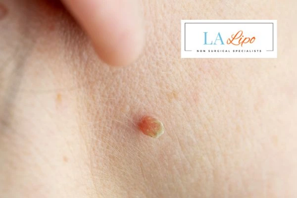 Book skin tag removal Golders Green today speak to our team now!