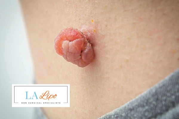 Interested in skin tag removal Golders Green? Concerned about the pain? Find out more today!