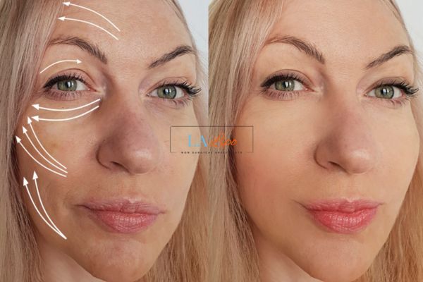 Morpheus 8 results Golders Green face lift.