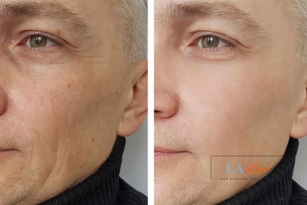 See the amazing results of Morpheus8 Treatment Golders Green!