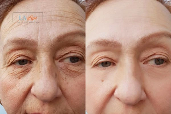 The powerful benefits of Morpheus8 Treatment Golders Green - Call Our team today!