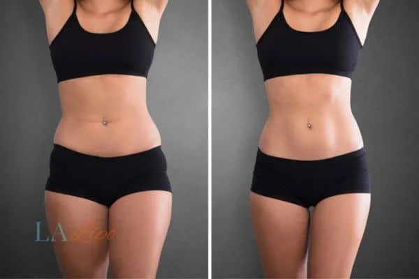 before and after results of non-surgical treatment to help a woman's body image and mental health Golders Green