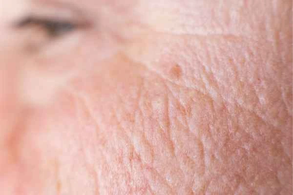 close up picture of a woman's face showing an age spot Golders Green