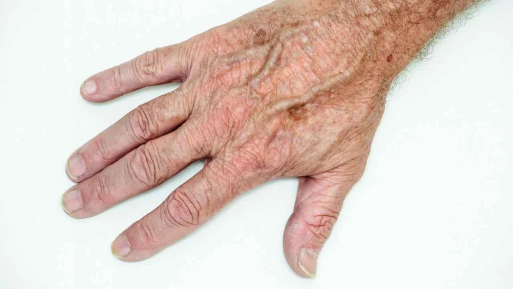 Male hand showing age spot Golders Green