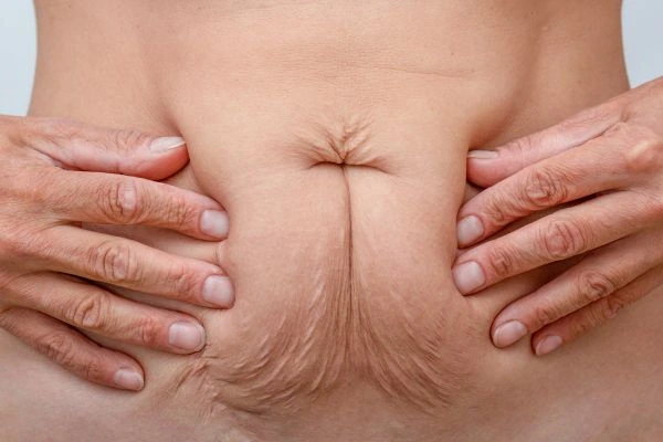 Image of a woman's stomach with loose skin - example of skin tightening Golders Green options