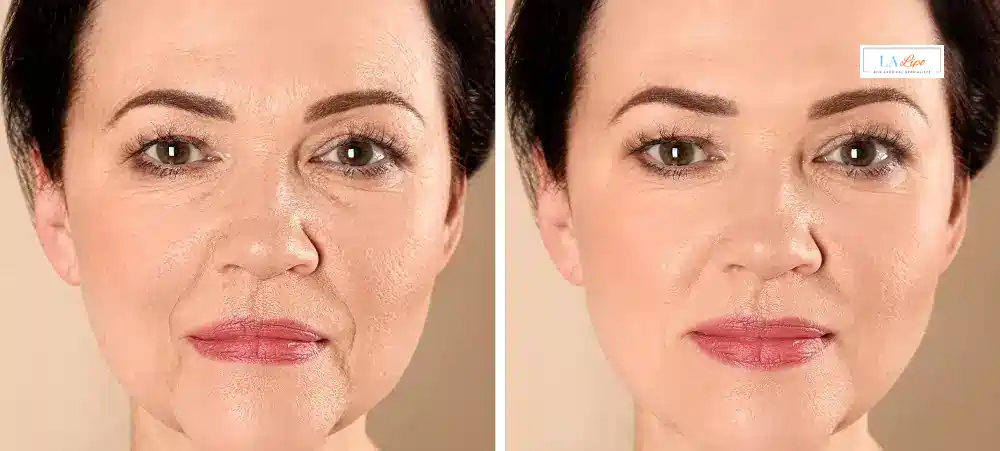 How Long Does It Take to See Results and How Long Do They Last Golders Green?
