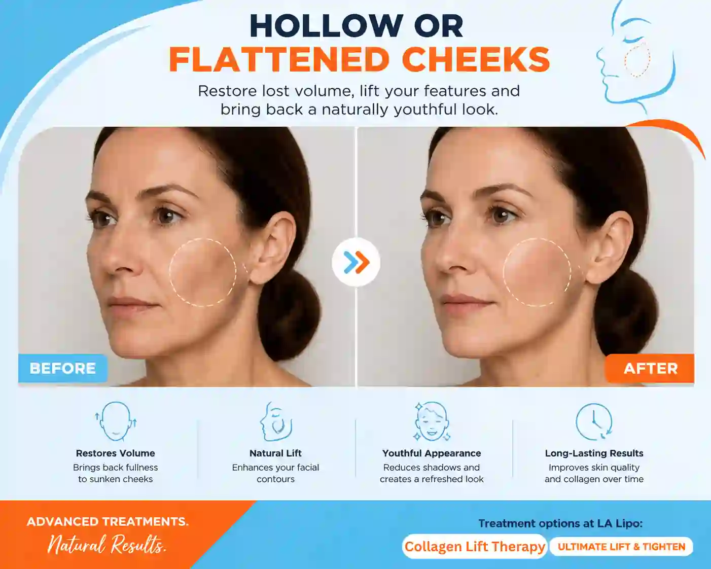 Sign #4: Hollow or Flattened Cheeks Golders Green