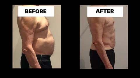 What Symptoms Can Diastasis Recti Cause in Men? Weak Core, Back Pain and Poor Posture Golders Green